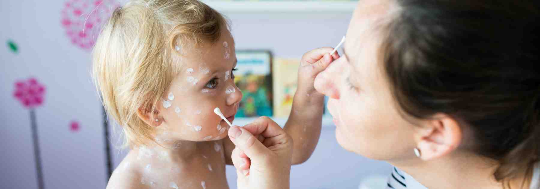 chickenpox vaccine in brixton