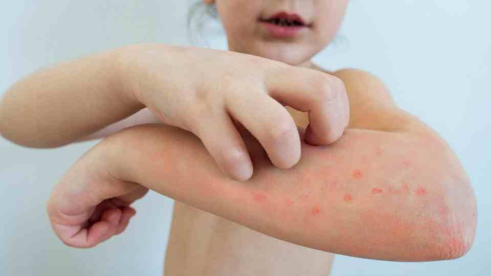 Private chickenpox vaccine